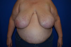 Breast Reduction Before and After Pictures Columbus, OH