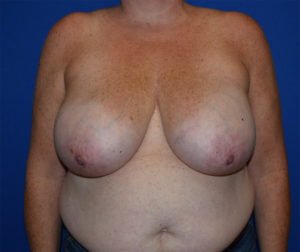 Breast Reduction Before and After Pictures Columbus, OH