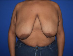 Breast Reduction Before and After Pictures Columbus, OH