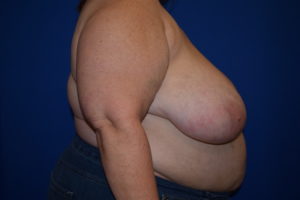 Breast Reduction Before and After Pictures Columbus, OH