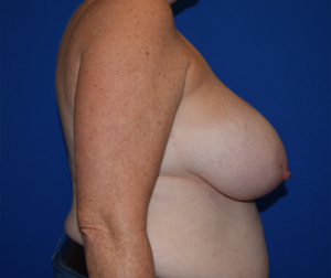 Breast Reduction Before and After Pictures Columbus, OH