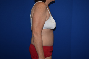 Tummy Tuck Before and After Pictures Columbus, OH