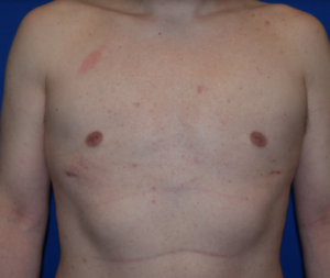 Gynecomastia Before and After Pictures Columbus, OH