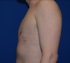 Gynecomastia Before and After Pictures Columbus, OH